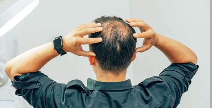 Bye Bye Kebotakan, Cukup Terapkan Tips berikut ini, Rambut Tebal dan Berkilau Jadi Milikmu