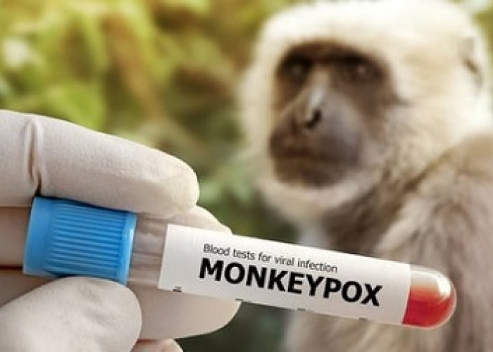Pasien Penyakit Cacar Monyet Pertama di Indonesia