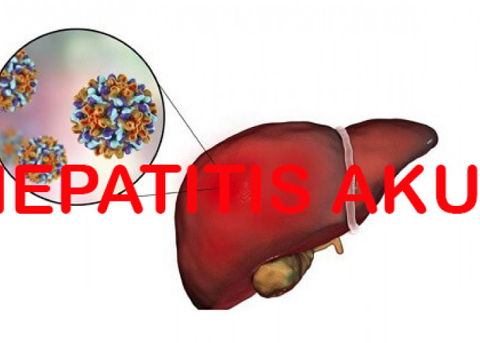 Kenapa Hepatitis Akut Disebut Misterius ?, Ini Menurut Dosen Prodi Keperawatan Lahat